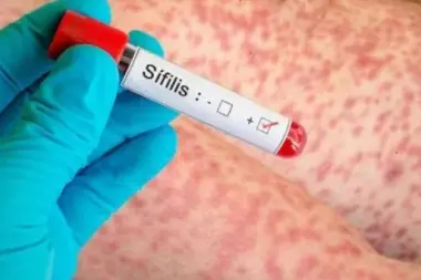 "En Argentina los casos de sífilis aumentaron aproximadamente el 40 por ciento"