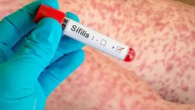 "En Argentina los casos de sífilis aumentaron aproximadamente el 40 por ciento"